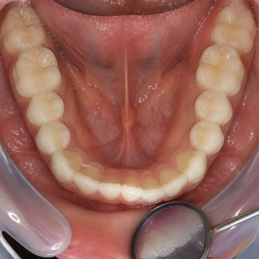 Dental aligners — close-up clinical photo of the result after treatment