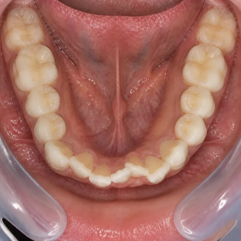 Dental aligners — before-treatment condition in a clinical photograph