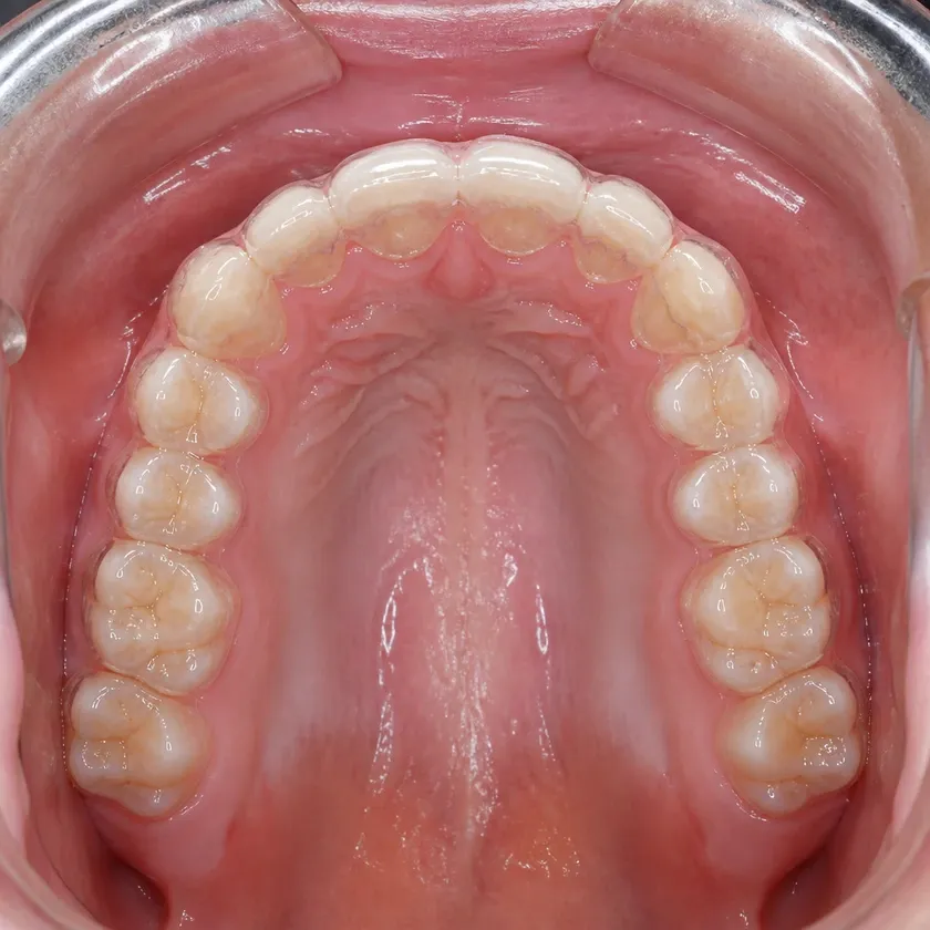 Dental alignment aligners — close-up clinical photo of the result after treatment