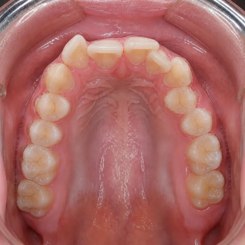 Dental aligners — before-treatment condition in a clinical photograph