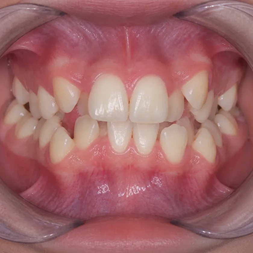 teeth alignment aligners for children in Astana — condition of teeth before treatment on the X-ray with