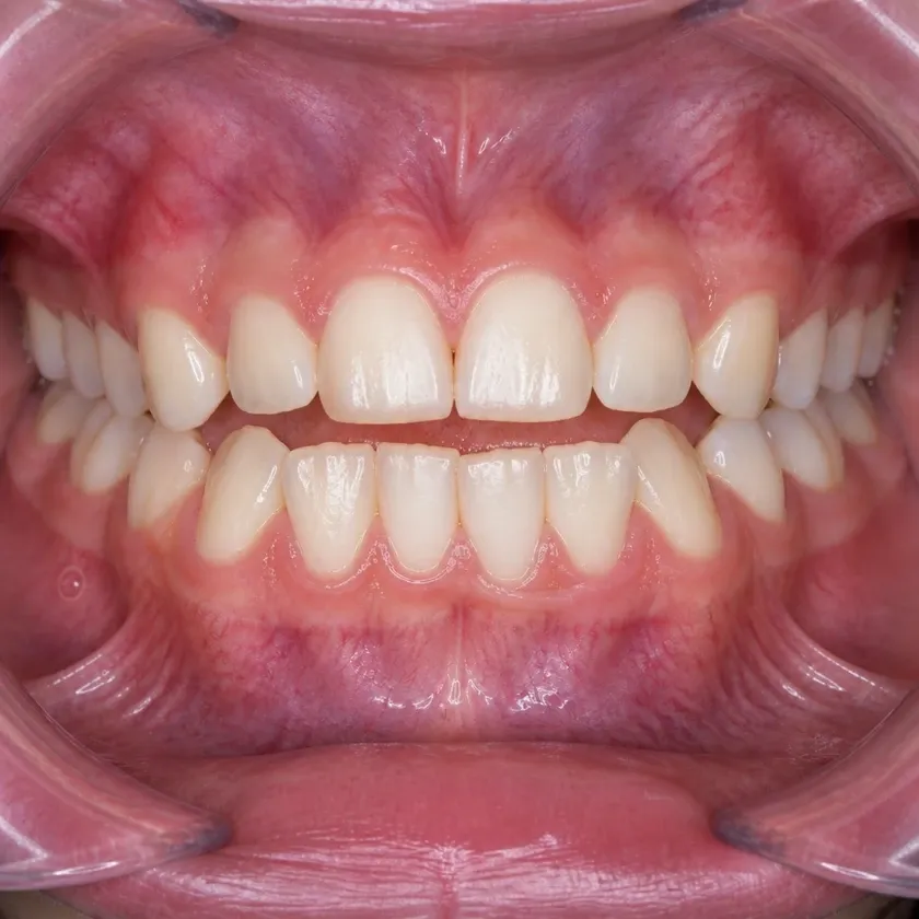 Aligners for teeth alignment in children — pre-treatment condition on a clinical image