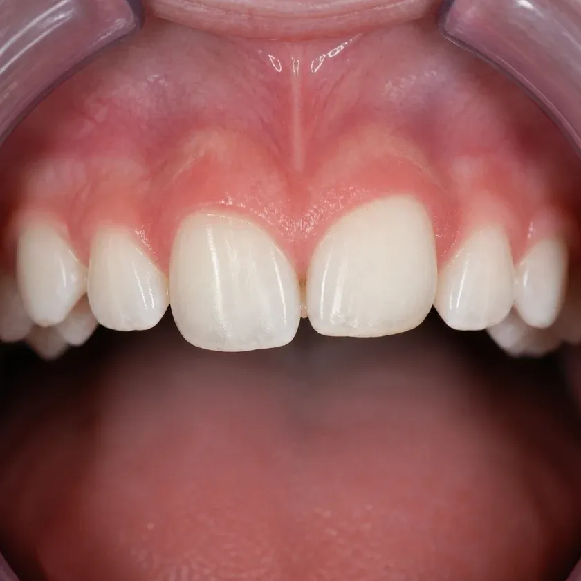 Aligners for teeth alignment in children — pre-treatment condition on a clinical image