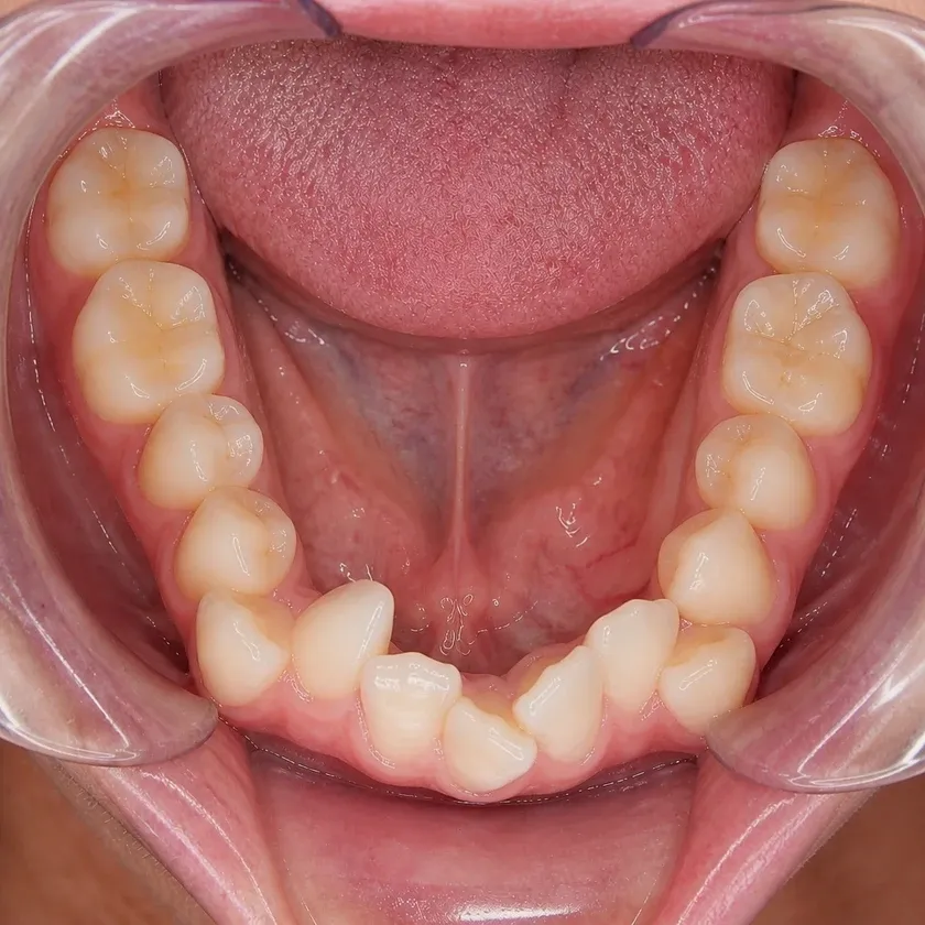 Invisalign каппалары — клиникалық суреттегі емге дейінгі жағдай