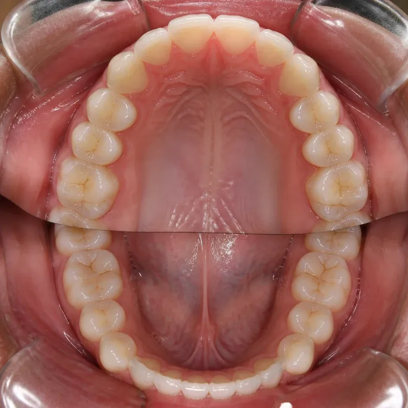 Invisalign каппалары — емдеу нәтижесі клиникалық суретте жақыннан