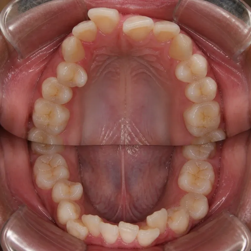 Invisalign каппалары — клиникалық суреттегі емге дейінгі жағдай