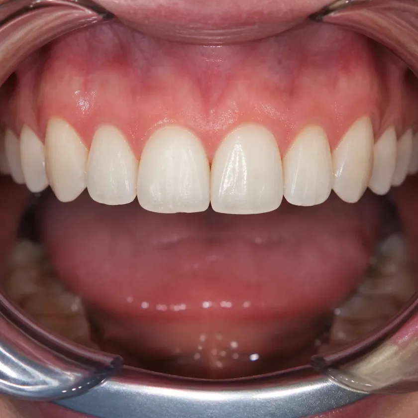 Invisalign каппалары — емдеу нәтижесі клиникалық суретте жақыннан