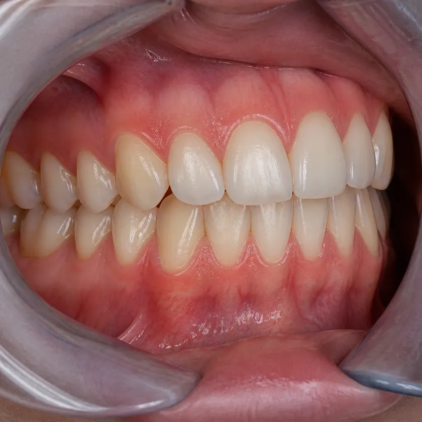 Invisalign каппалары — клиникалық суретте емдеуден кейінгі нәтиже жақыннан