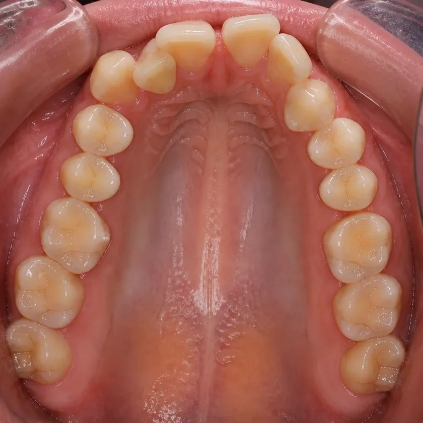 Invisalign каппалары — клиникалық суреттегі емге дейінгі жағдай