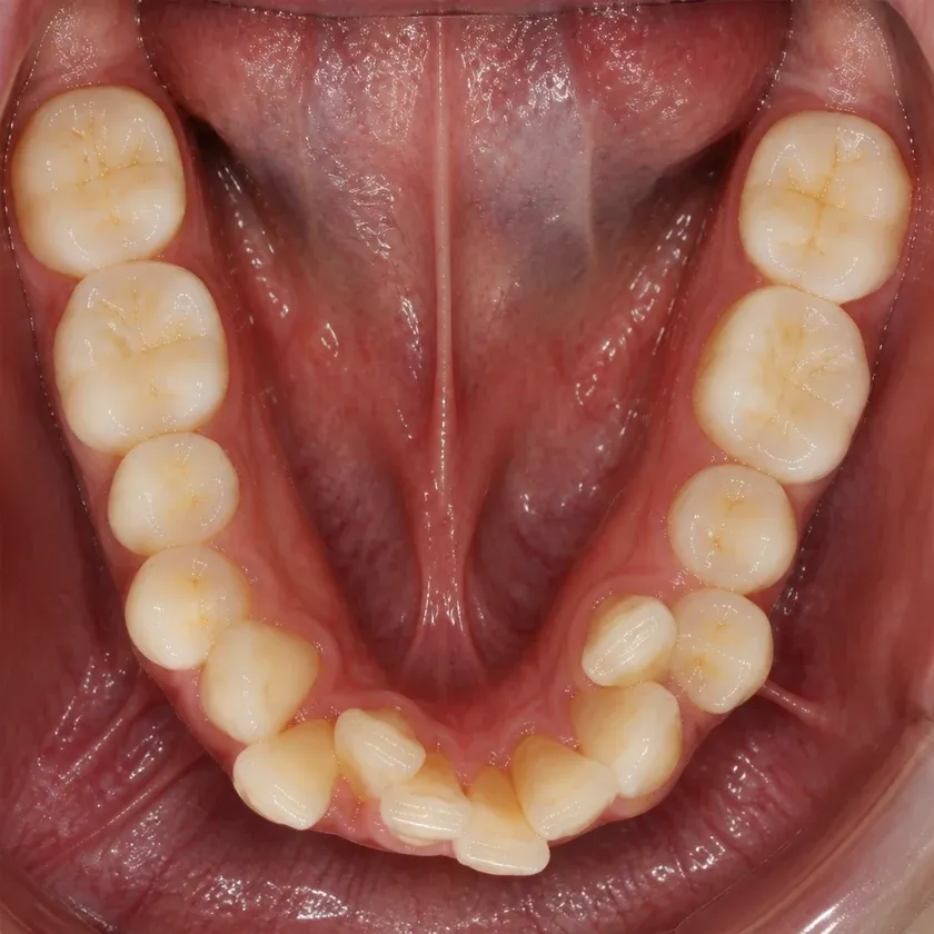 Invisalign каппалары — клиникалық суреттегі емге дейінгі жағдай