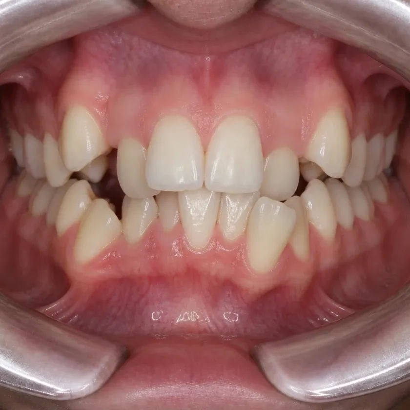 Invisalign каппалары — клиникалық суреттегі емге дейінгі жағдай