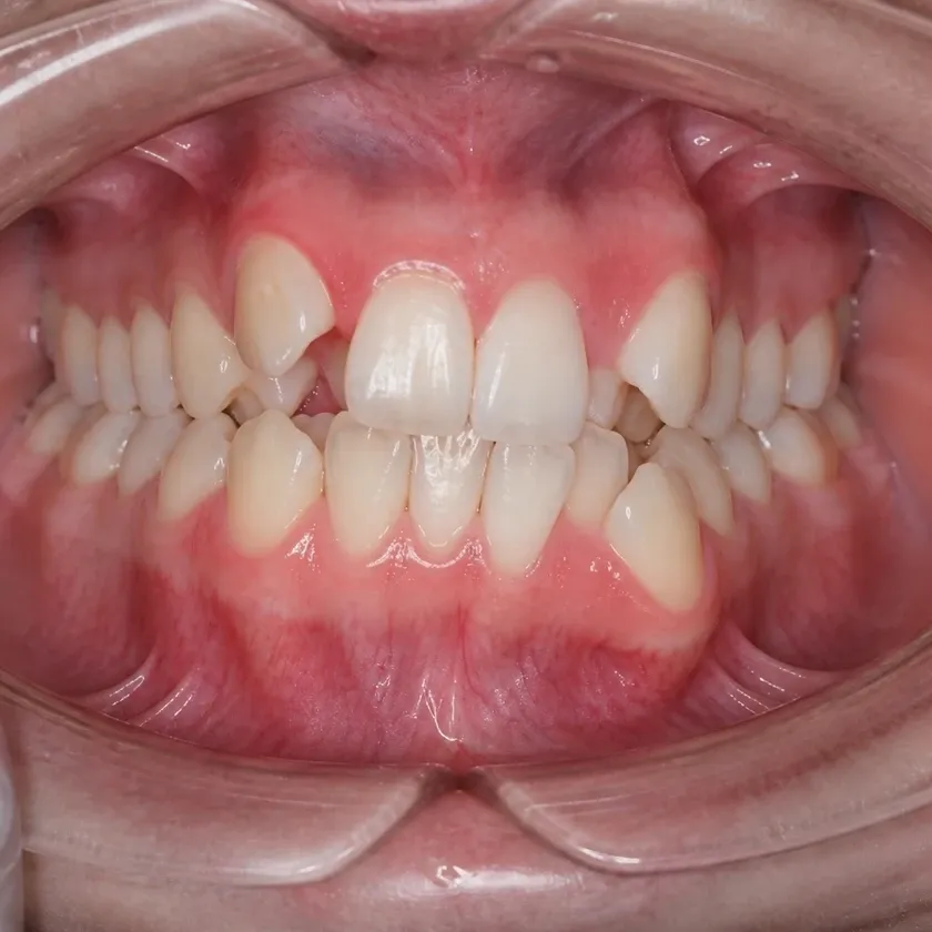 Ceramic braces — before-treatment condition in a clinical photograph