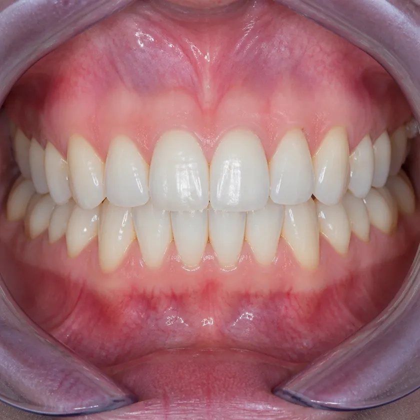 ceramic braces Astana — close-up result after treatment on a clinical photograph