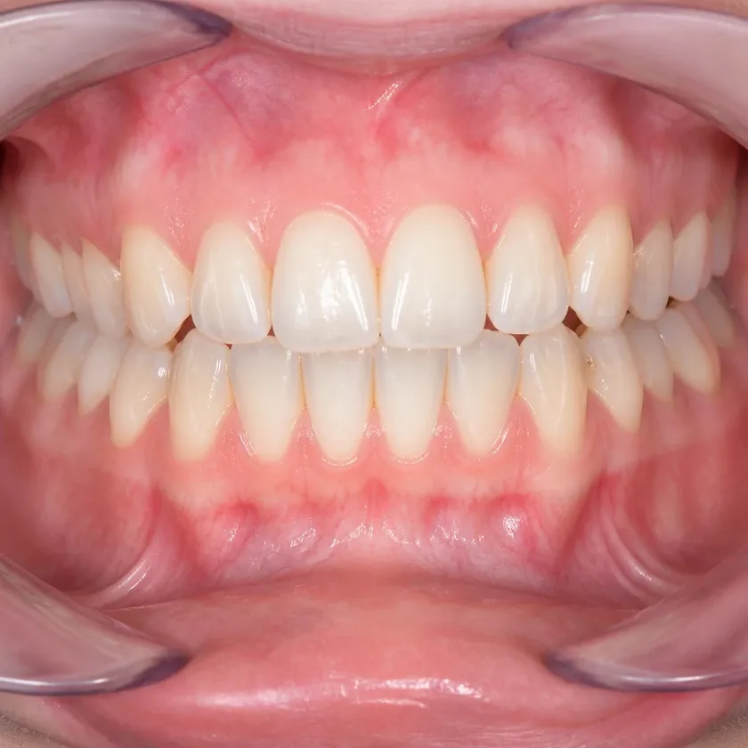 ceramic braces Astana — close-up result after treatment on a clinical photograph