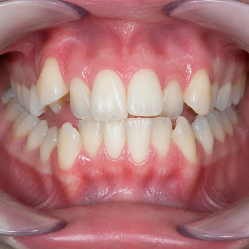 Ceramic Damon Clear braces — before-treatment condition in a clinical photograph