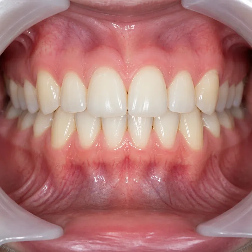 ceramic braces Astana — close-up result after treatment on a clinical photograph