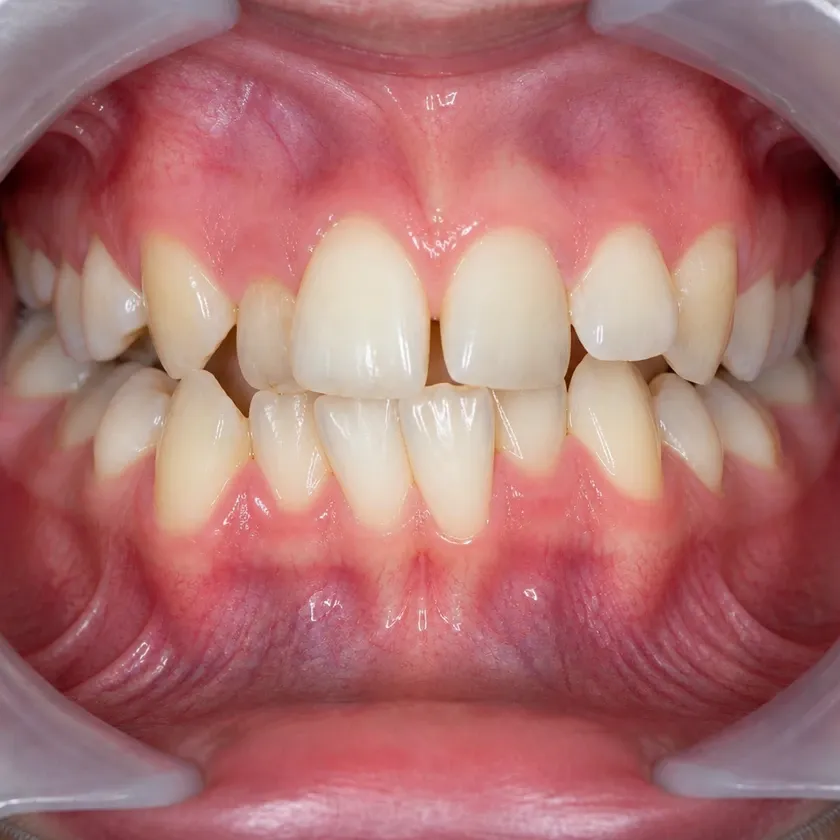 Ceramic Damon Clear braces — before-treatment condition in a clinical photograph