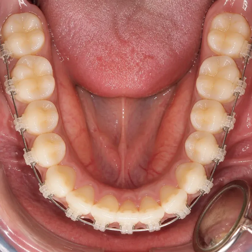 Ceramic braces — close-up clinical photo of the treatment result