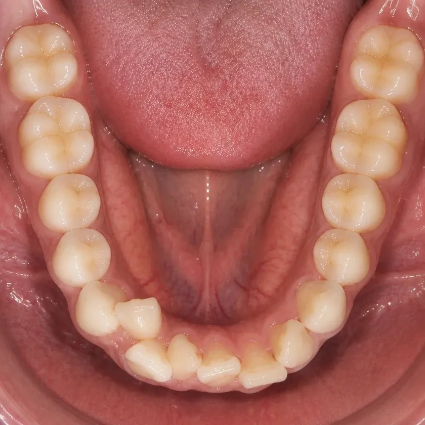 Ceramic braces — before-treatment condition in a clinical photograph