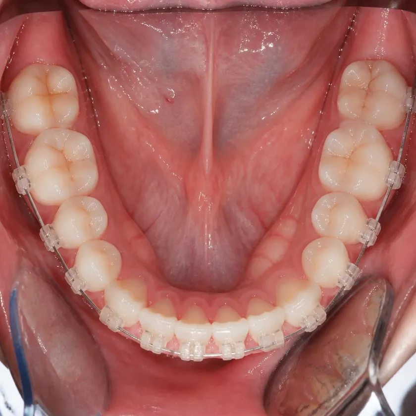 Ceramic braces — close-up clinical photo of the treatment result