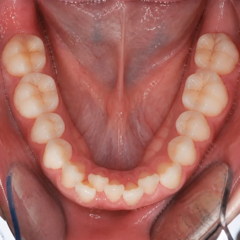 Ceramic braces — before-treatment condition in a clinical photograph