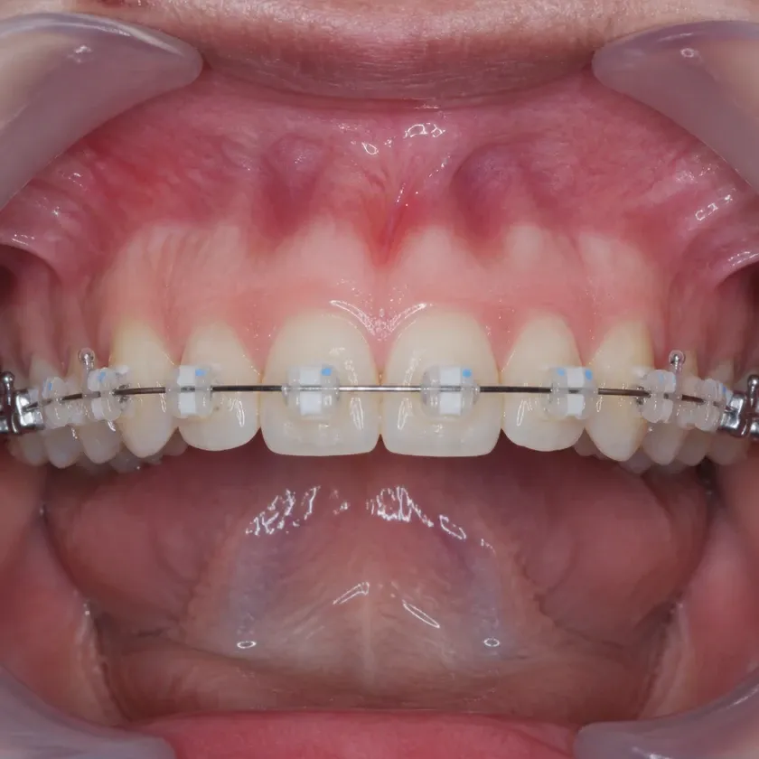 Ceramic braces — close-up of the treatment result in a clinical photograph
