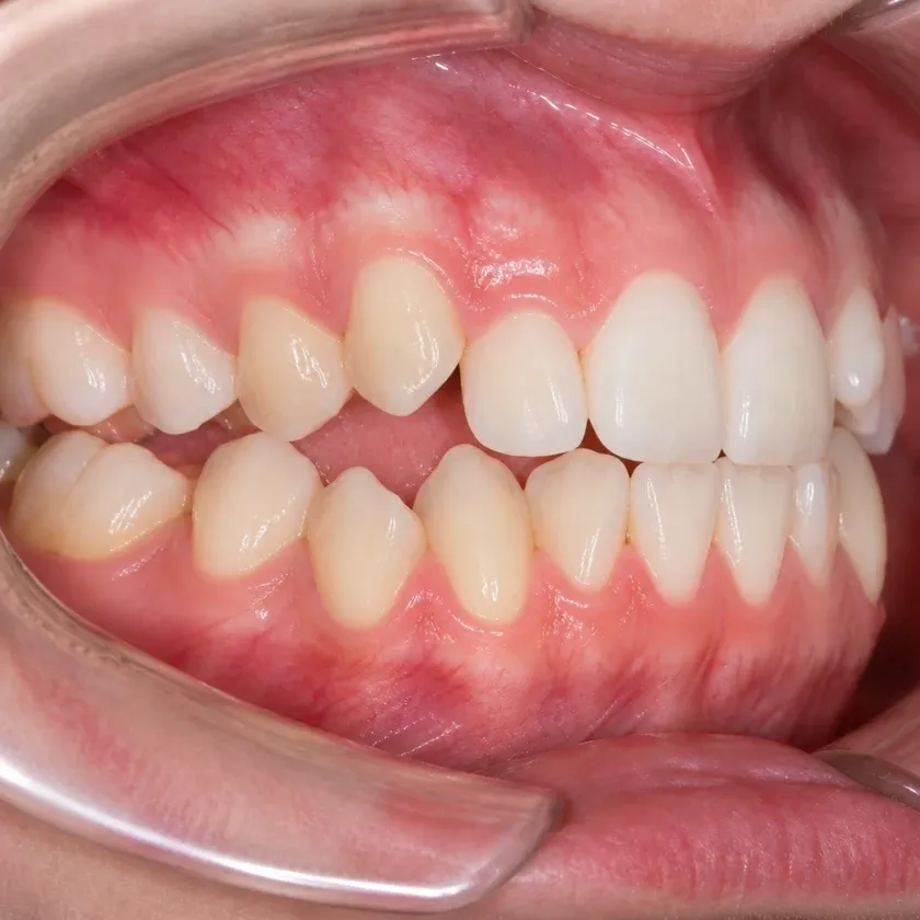 Ceramic braces — before-treatment condition in a clinical photograph