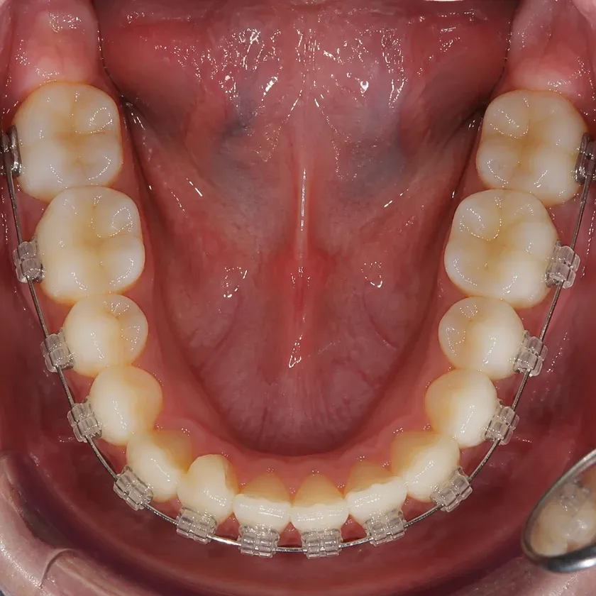 Ceramic Damon Clear braces — close-up clinical photo of the result after treatment