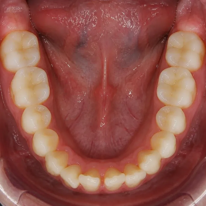 Ceramic Damon Clear braces — before-treatment condition in a clinical photograph