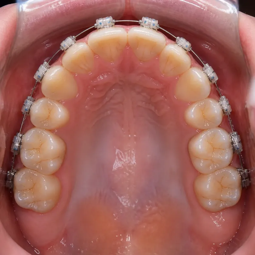 Ceramic Damon Clear braces — close-up clinical photo of the result after treatment
