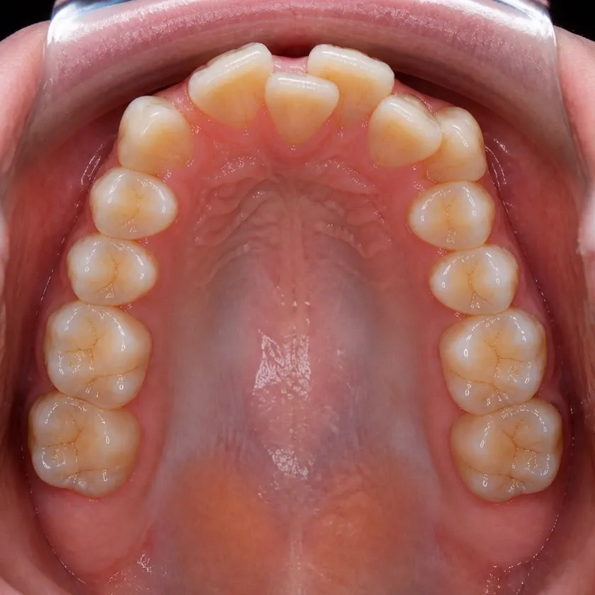 Ceramic Damon Clear braces — before-treatment condition in a clinical photograph