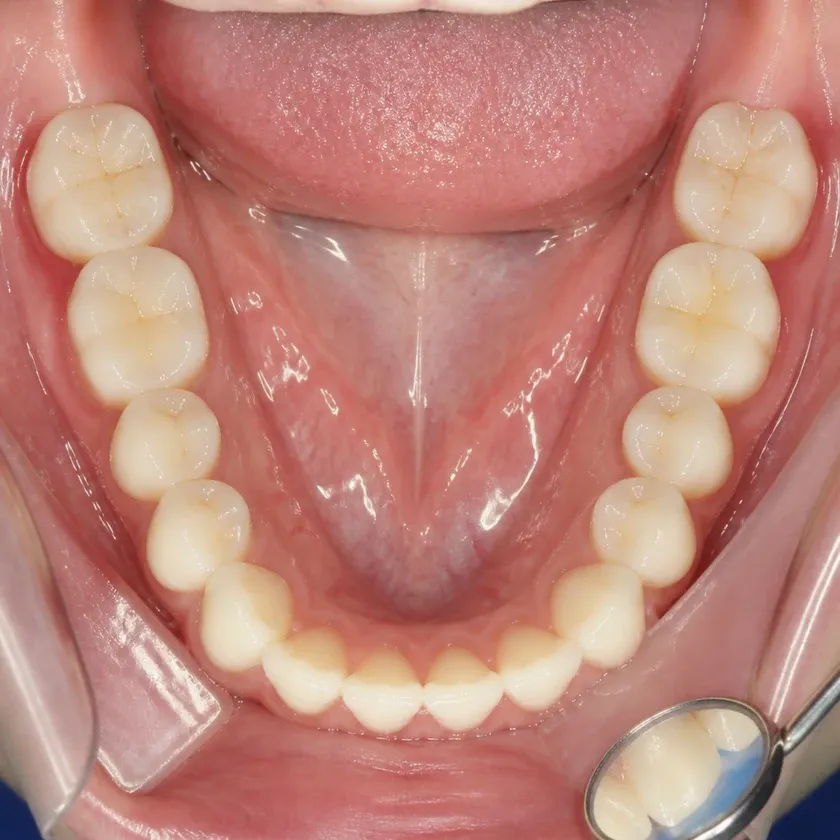 Korean dental implants — close-up clinical image of the result after treatment