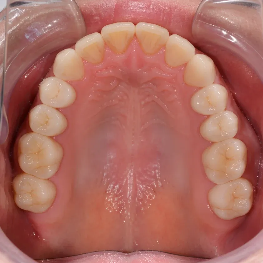 Korean dental implants — close-up clinical image of the result after treatment