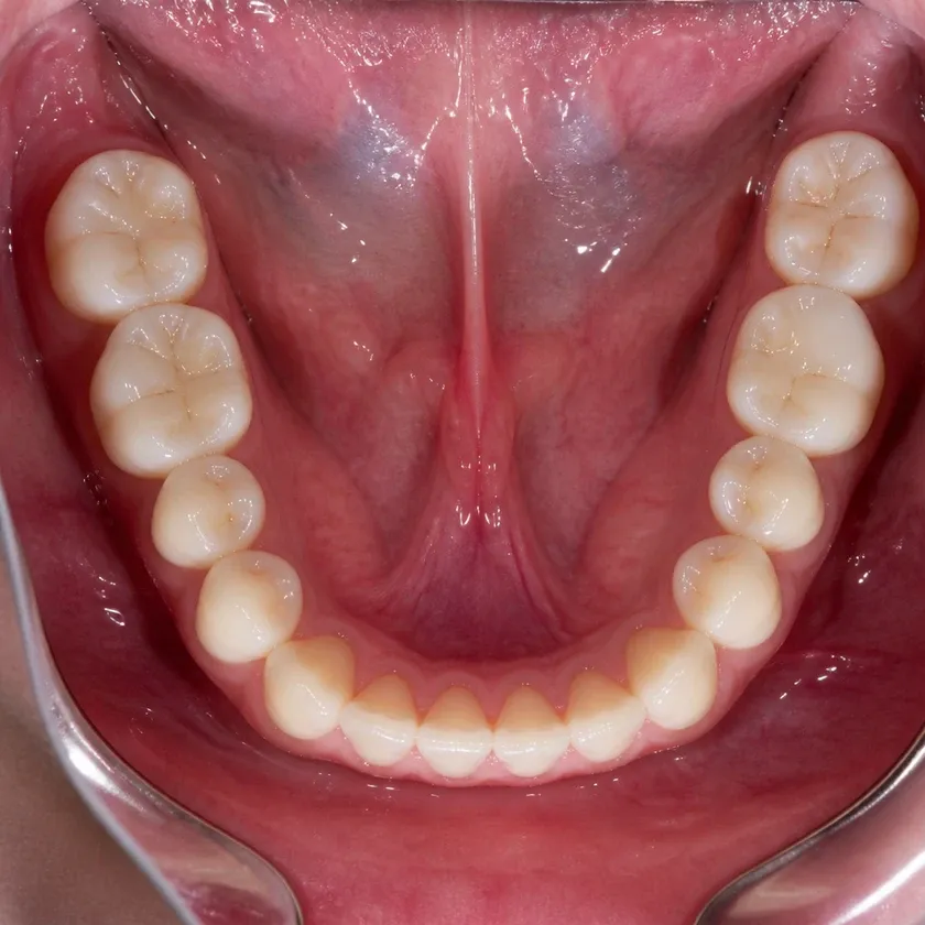 Laser dental implantation — close-up clinical photo of the result after treatment