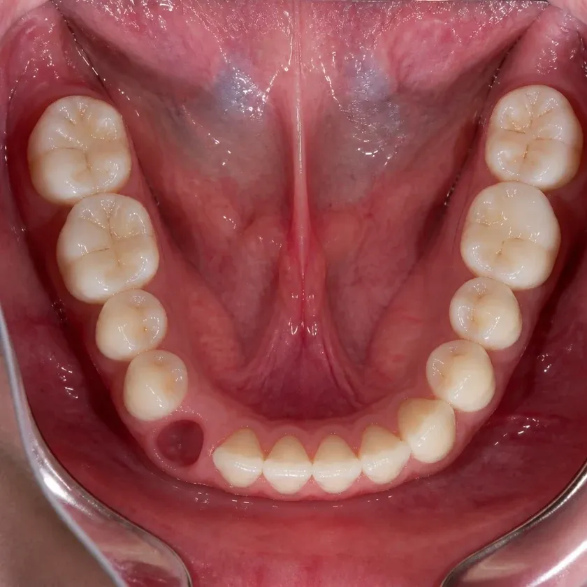 Laser dental implantation — pre-treatment condition on a clinical image