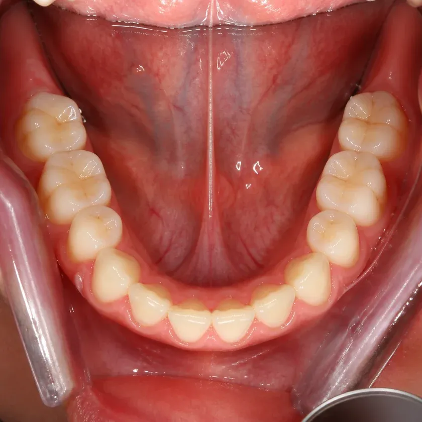 Laser dental implantation — close-up clinical photo of the result after treatment
