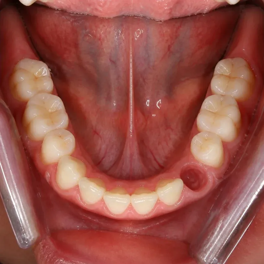 Laser dental implantation — pre-treatment condition on a clinical image
