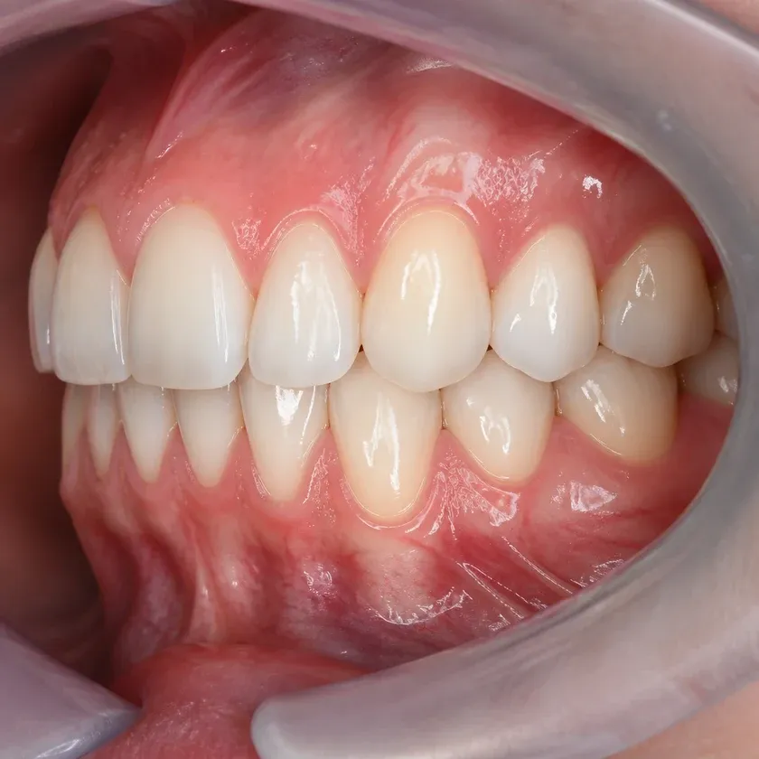 Laser dental implantation — close-up clinical image of the result after treatment