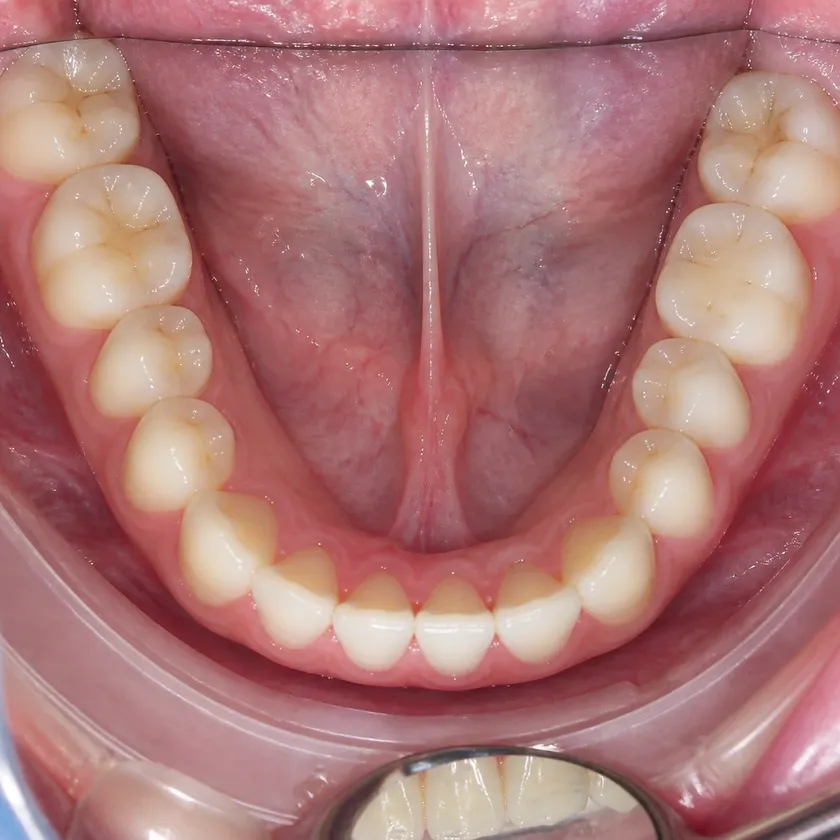 Gum treatment with the Vector system — close-up clinical photograph showing the result after treatment