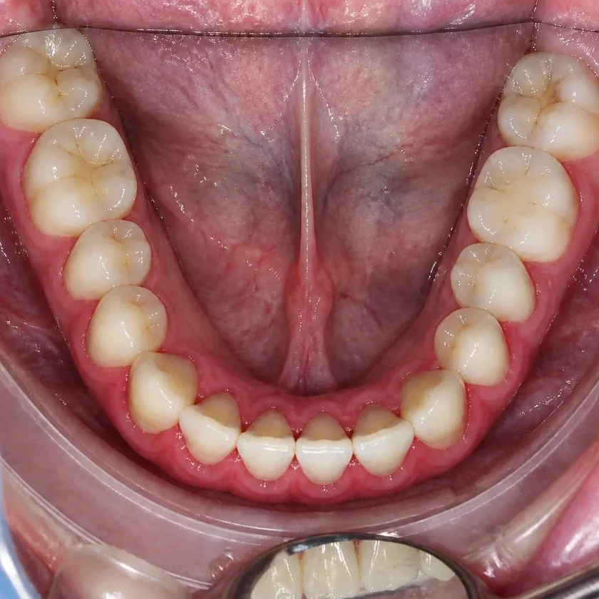 Gum treatment with the Vector device — before-treatment condition on a clinical image