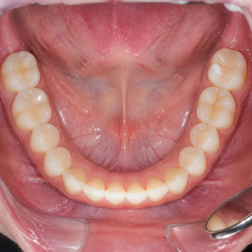 Gum treatment with the Vector system — close-up clinical photograph showing the result after treatment