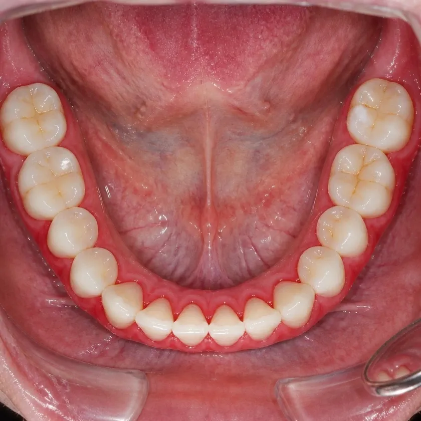 Gum treatment with the Vector device — before-treatment condition on a clinical image