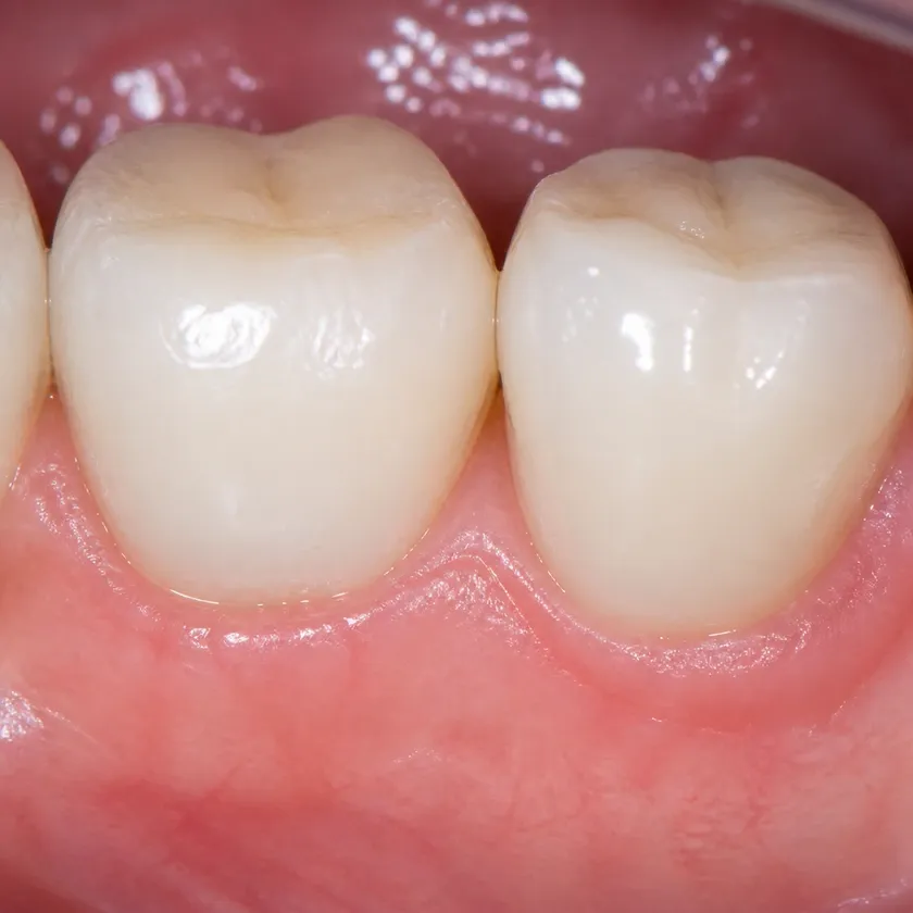 Gum treatment with the Vector device — close-up of the treatment result in a clinical image