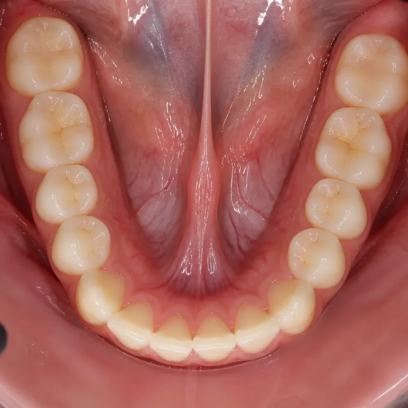 Gum treatment with the Vector device — close-up clinical image of the result after treatment