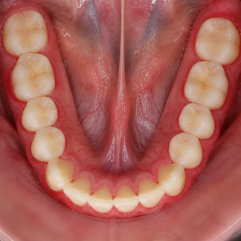 Gum treatment with the Vector device — before-treatment condition on a clinical image