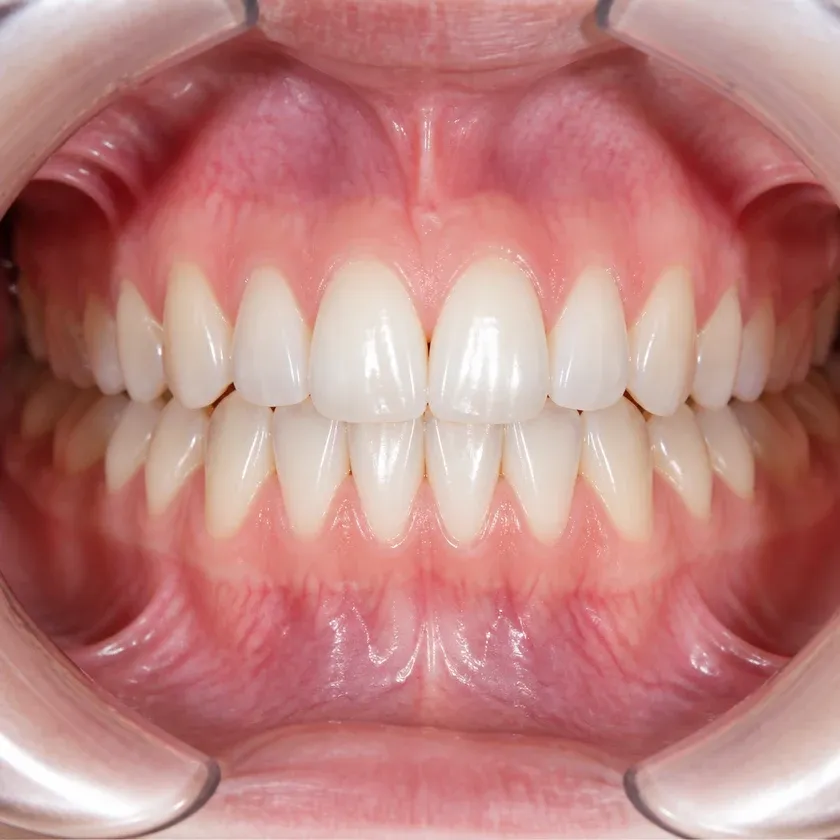 gum treatment with the Vector device — close-up result after treatment on a clinical image