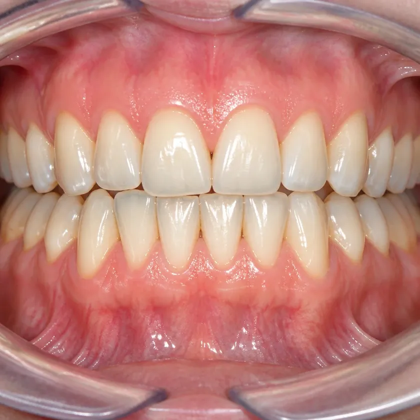 Laser gum treatment — close-up clinical photo of the result after treatment