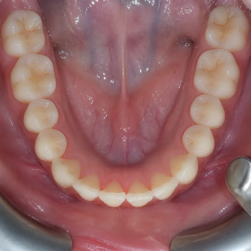 Periodontitis treatment — close-up clinical image showing the result after treatment