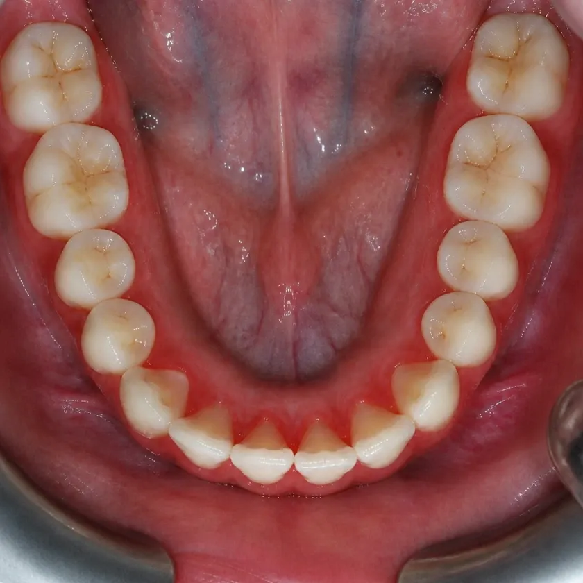 Periodontitis treatment — before-treatment condition on a clinical image