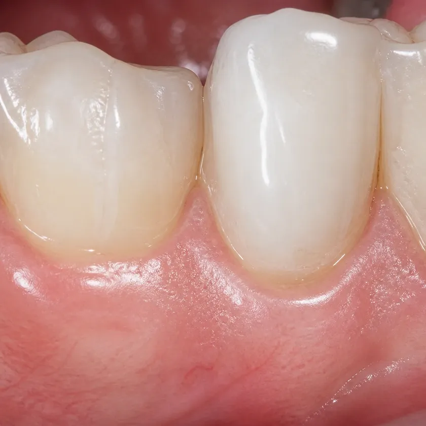 Periodontitis treatment — close-up of the treatment result on a clinical image